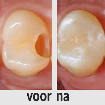 De tandarts boort een gaatje uit zodat de vulling beter hecht;