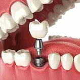 Tandheelkunde Goudsesingel plaatst implantaten met een titanium kunstwortel;